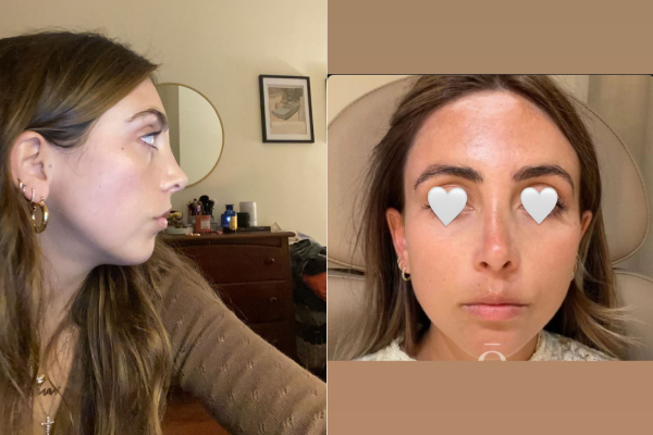 rhinoplasty results three and nine years after the procedure